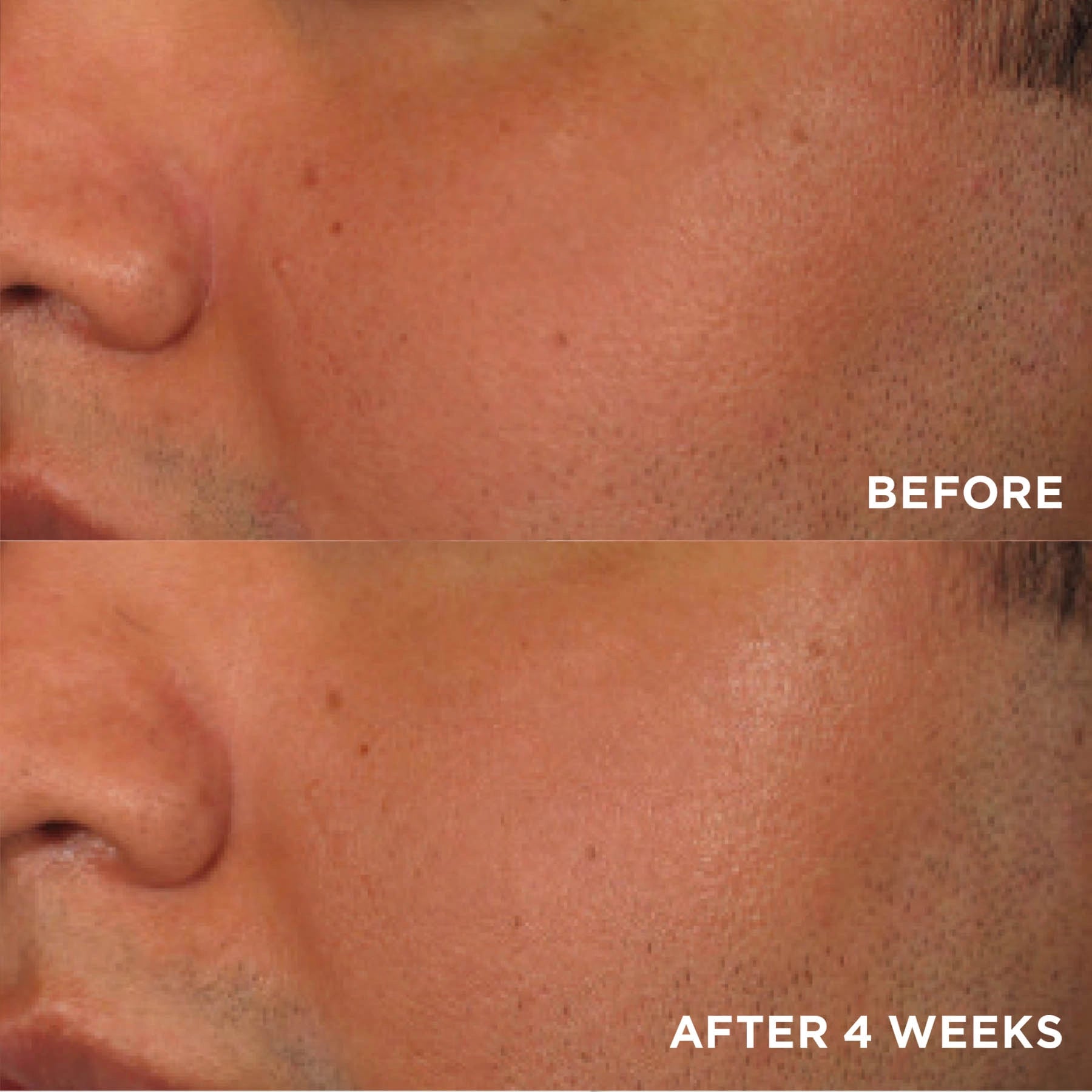 Before and after comparison of a person's skin on a close-up of the face.