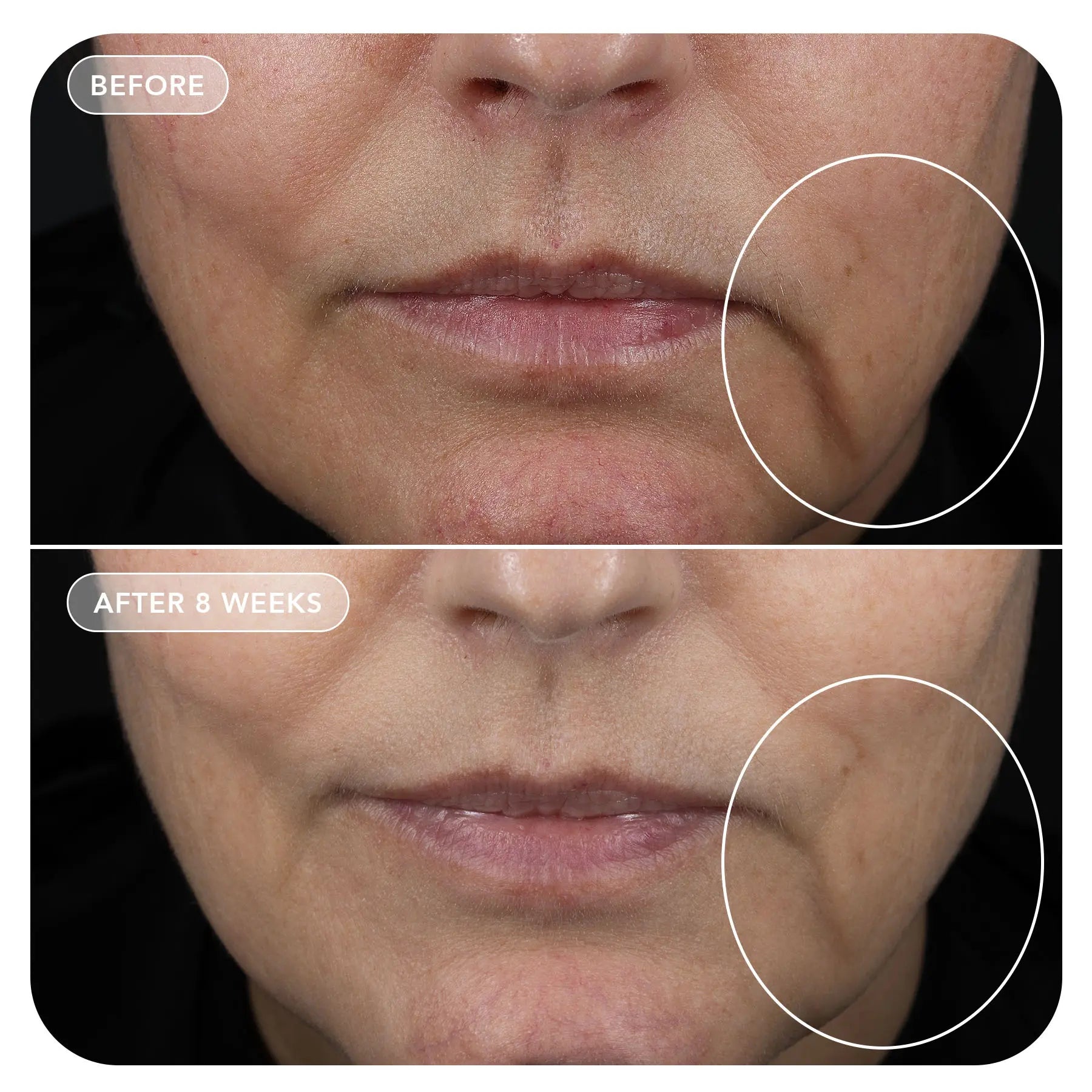 VOL.U.LIFT™ GLP-1 4D Skin Rebound Complex
