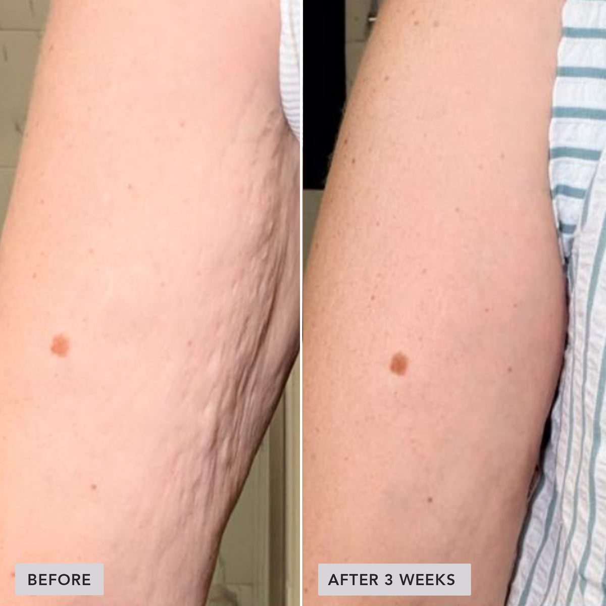 A side-by-side before and after comparison of a person's upper arm, showing stretch marks and skin texture improvement after 3 weeks. The left panel is labeled 'BEFORE' and the right panel 'AFTER 3 WEEKS'.