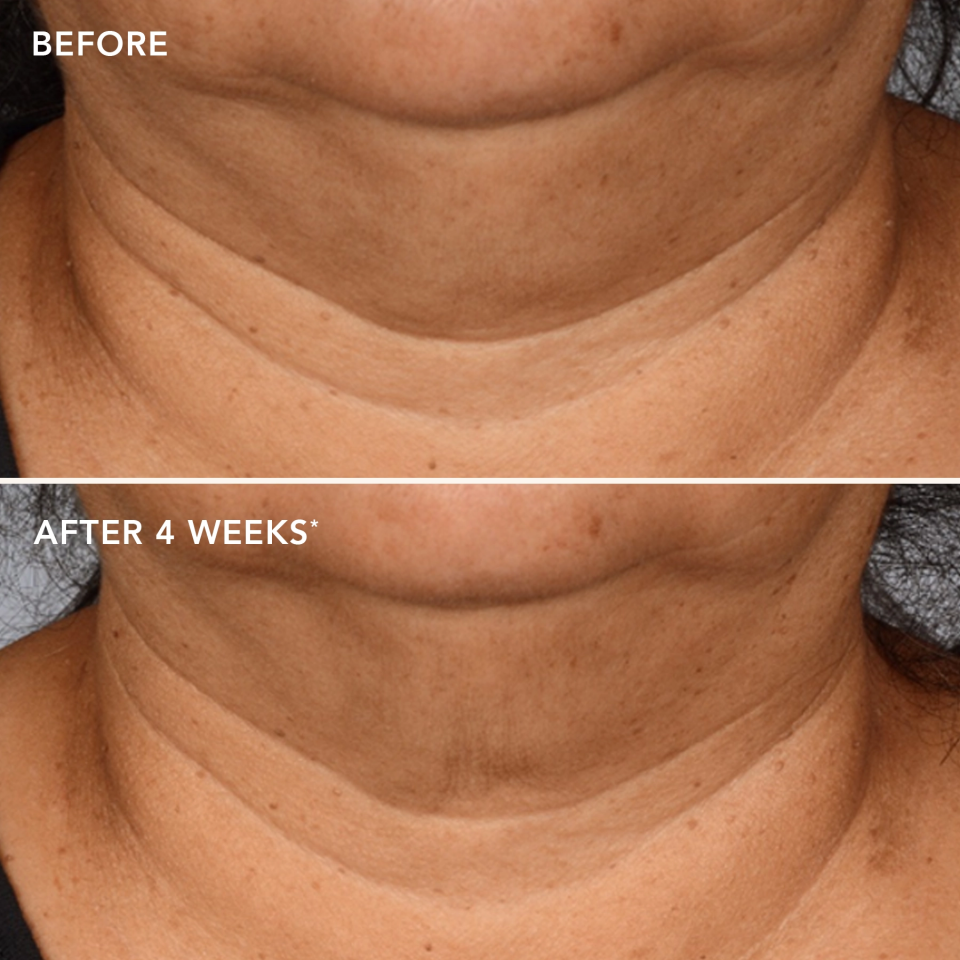Before and after comparison of neck skin texture with 'Before' showing more visible lines and 'After 4 Weeks' showing improved texture.
